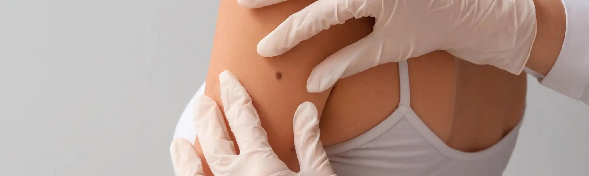 Czerniak skóry: jak zapobiegać i dbać o bezpieczeństwo skóry Czerniak skóry: jak zapobiegać i dbać o bezpieczeństwo skóry