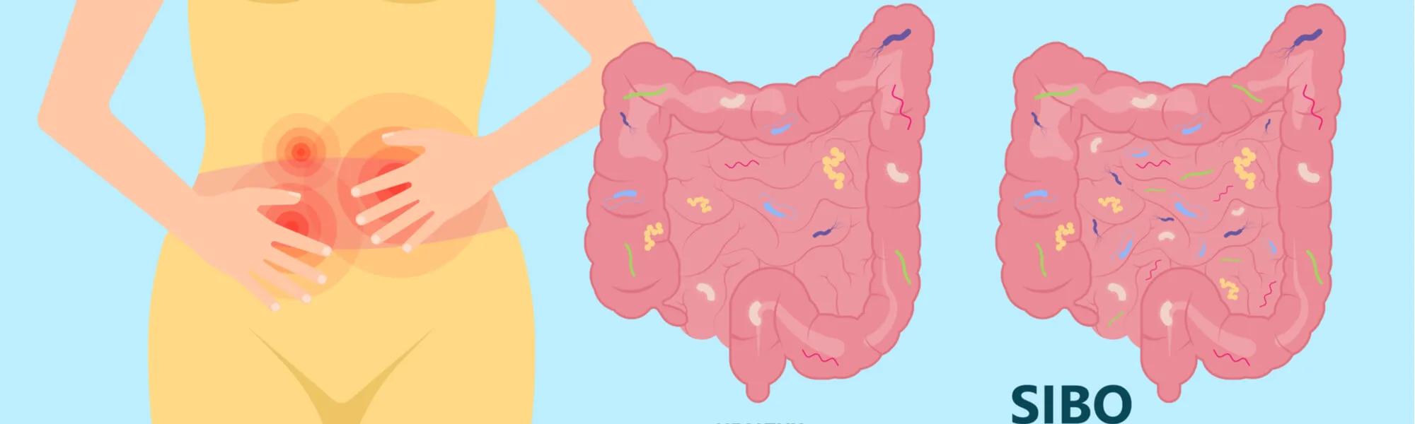SIBO - co to, objawy, leczenie. Teraz wykonasz test na SIBO w domu SIBO - co to, objawy, leczenie. Teraz wykonasz test na SIBO w domu
